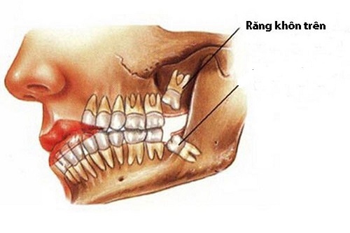 Răng khôn hàm trên bị vỡ - Liệu có nên nhổ? 1