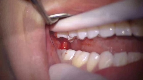Răng khôn hàm trên bị vỡ - Liệu có nên nhổ? 2