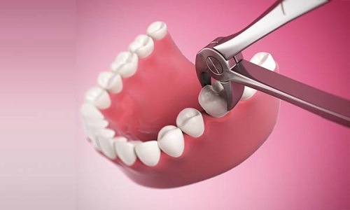 Răng khôn làm sâu răng số 7 - Cách xử lý hiệu quả nhất 1