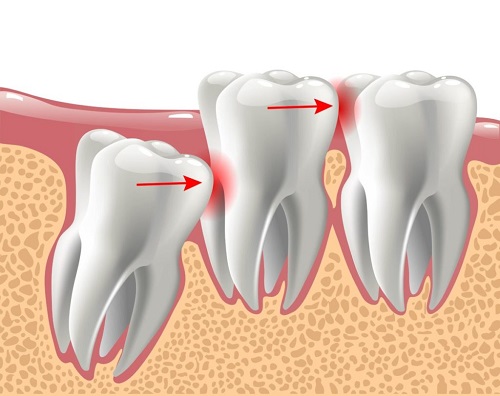 Răng khôn làm sâu răng số 7 - Cách xử lý hiệu quả nhất 2