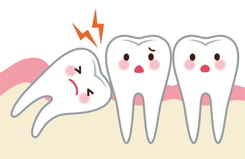 Răng khôn làm sâu răng số 7 - Cách xử lý hiệu quả nhất 3