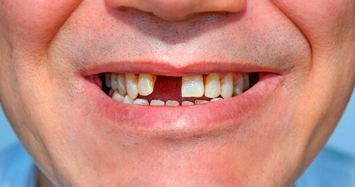 Trồng răng bằng cầu răng sứ là gì? 1