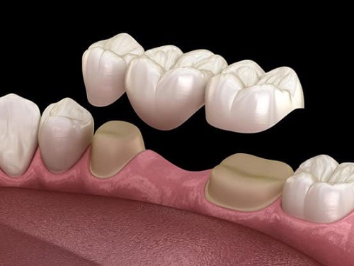Trồng răng bằng cầu răng sứ là gì? 2