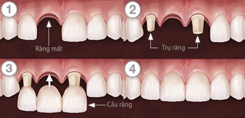 Trồng răng bằng cầu răng sứ là gì? 3