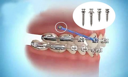 Cắm vít niềng răng bị sưng - Cách xử lý từ nha khoa 1
