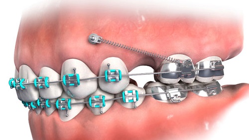 Cắm vít niềng răng bị sưng - Cách xử lý từ nha khoa 2