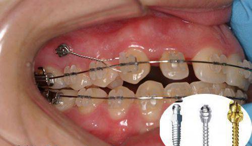 Cắm vít niềng răng bị sưng - Cách xử lý từ nha khoa 3