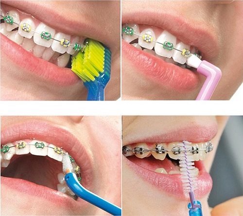 Niềng răng nên dùng bàn chải gì? Tham khảo từ nha khoa 1