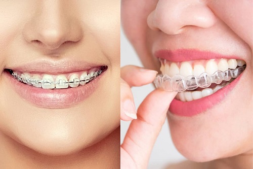 Niềng răng bị viêm lợi - Nguyên nhân - Hậu quả - Cách xử lý 1