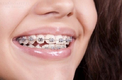 Niềng răng bị viêm lợi - Nguyên nhân - Hậu quả - Cách xử lý 2