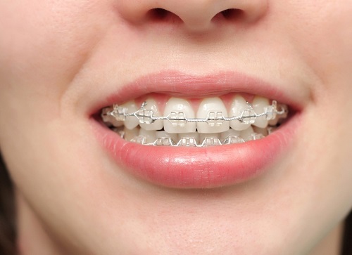 Niềng răng bị viêm lợi - Nguyên nhân - Hậu quả - Cách xử lý 3