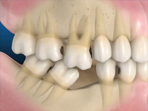 Trồng răng có chân răng thực hiện dễ không? 1
