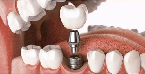 Trồng răng có chân răng thực hiện dễ không? 2