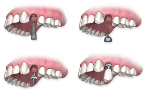 Trồng răng có chân răng thực hiện dễ không? 3