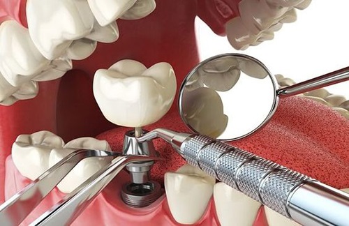 Trồng răng cối khắc phục được các biến chứng gì? 3