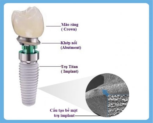 Kinh nghiệm làm răng implant - Chia sẻ từ khách hàng 3