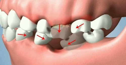 Mất răng lâu năm có trồng được không? Tham khảo ý kiến chuyên gia 1