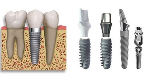 Mất răng lâu năm có trồng được không? Tham khảo ý kiến chuyên gia 3 Mất răng lâu năm có trồng được không? Tham khảo ý kiến chuyên gia 3