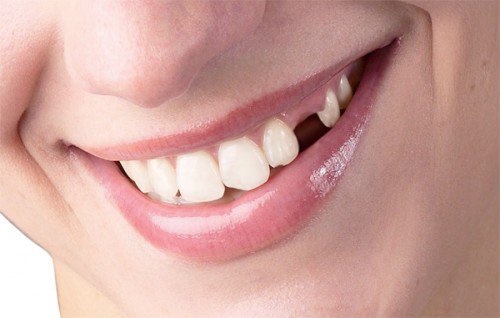Trồng răng bị rụng - Áp dụng kỹ thuật tại nha khoa 1