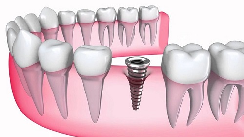 Trồng răng bị rụng - Áp dụng kỹ thuật tại nha khoa 2