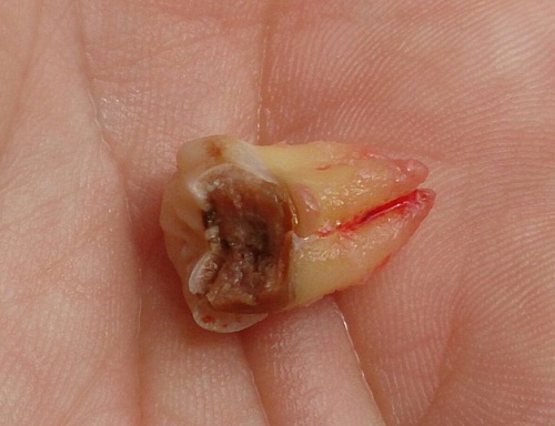Răng khôn hàm trên bị sâu - Xử lý dứt điểm với các cách sau 2