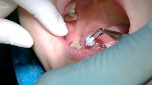 Răng khôn hàm trên bị sâu - Xử lý dứt điểm với các cách sau 3