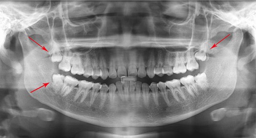 Chụp x quang răng khôn bao nhiêu tiền là hợp lý? 2