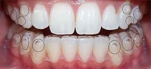 Dụng cụ niềng răng tại nhà có tốt không? 3 Dụng cụ niềng răng tại nhà có tốt không? 3