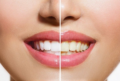 Niềng răng xong có nên tẩy trắng răng không? 2