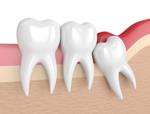 Răng khôn bị sâu chảy máu có nguy hiểm không? 1