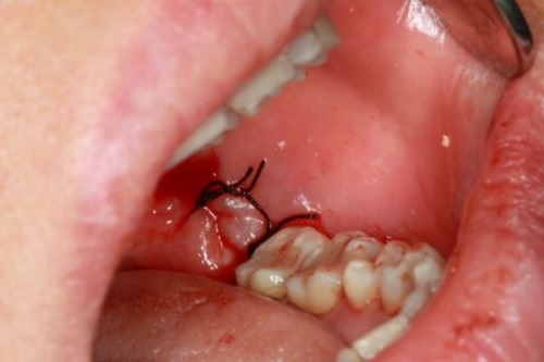 Răng khôn bị sâu chảy máu có nguy hiểm không? 2