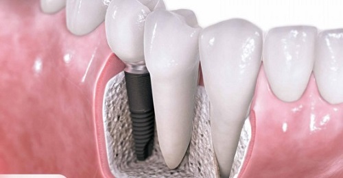 Trồng răng kiêng ăn gì? Bạn có biết? 3