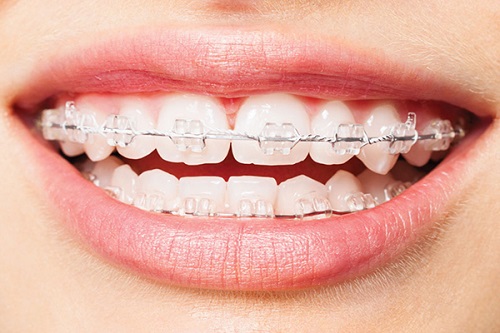 Trồng răng giả có niềng được không? Bác sĩ có kinh nghiệm tư vấn 1