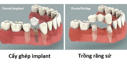 Trồng răng hàm implant giá bao nhiêu? Tìm hiểu giá niêm yết 2