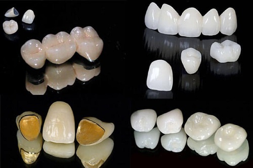 Trồng răng hàm implant giá bao nhiêu? Tìm hiểu giá niêm yết 3