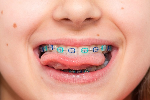 Niềng răng cho trẻ em ở đâu tphcm là tốt? 1
