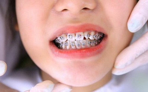 Niềng răng cho trẻ em ở đâu tphcm là tốt? 3
