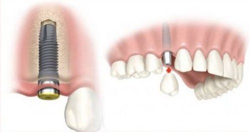 Trẻ em có trồng răng implant được không? Bác sĩ tư vấn 1