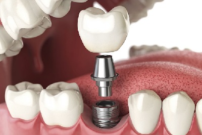 Khám phá quy trình trồng răng implant-1
