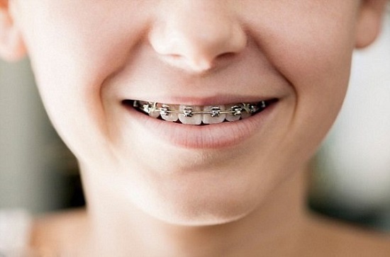 Niềng răng cho trẻ em có đau không? Những vấn đề bạn cần lưu ý 2